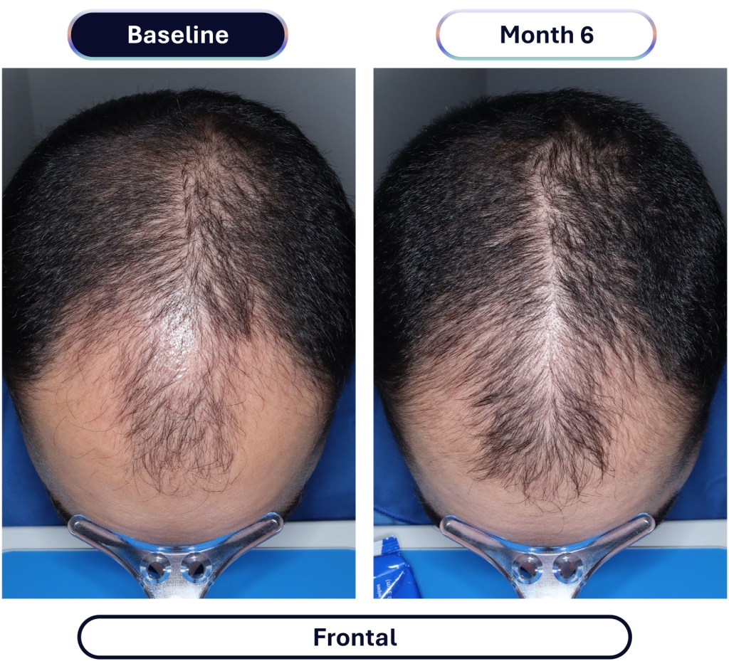 Experimental hair loss pill just cleared a major hurdle — when it could hit shelves