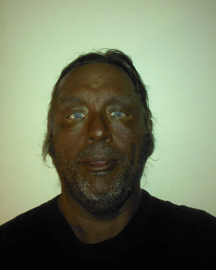 does melanotan permanently darken skin Man warns against 'dangerous' tanning injections after turning so dark he 'looked like Madge from Benidorm' Melanotan II: Tanning injections, nasal