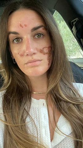 Victoria Nelson's face after seeing Sonya Dakar for a chemical treatment in 2021Credit: Victoria Nelson/TikTok