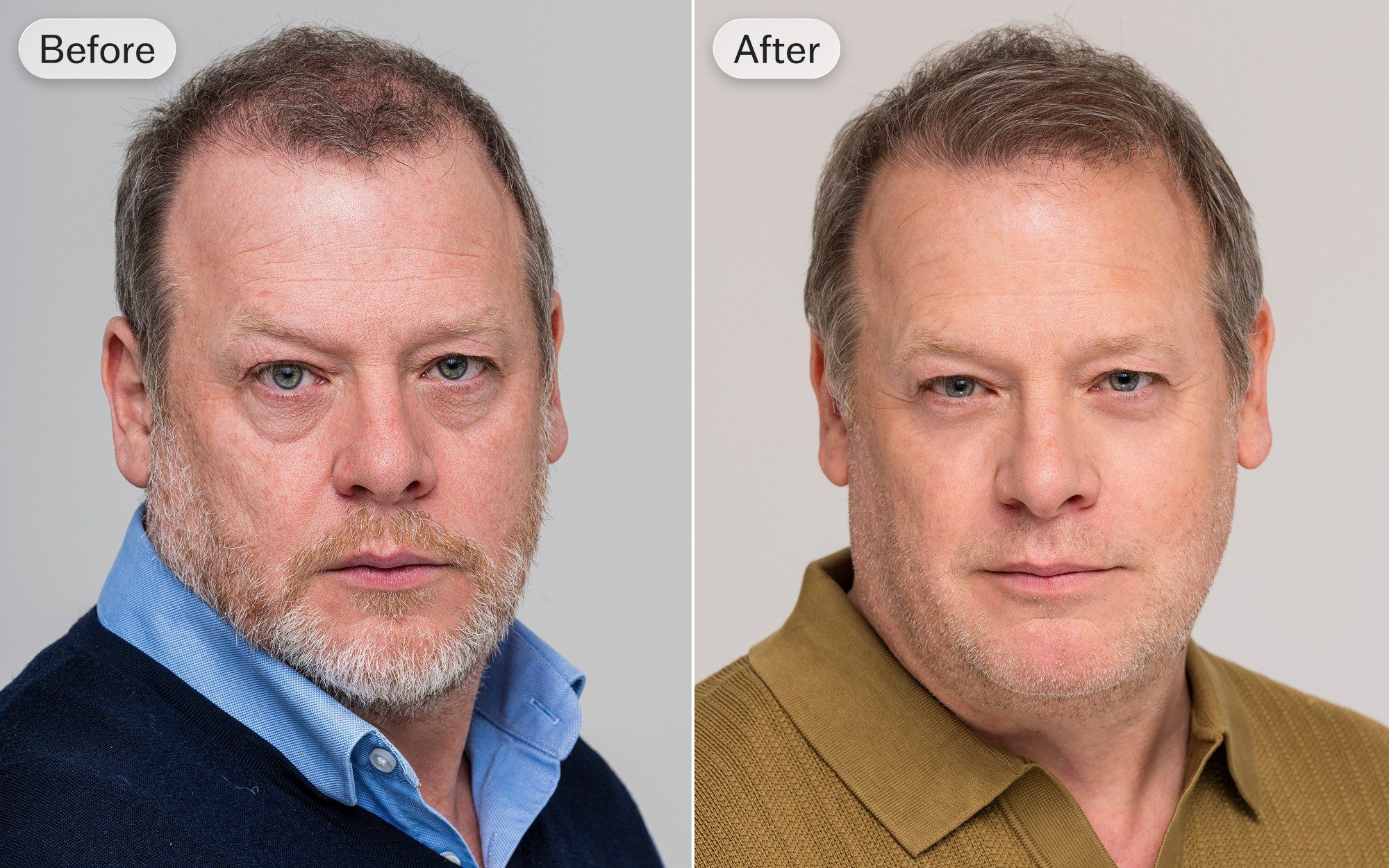 ghk cu before and after At 53 I swapped soap for acid peels and lasers – finally my eye bags are  gone