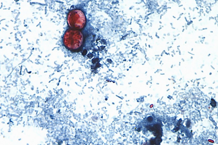 Another case of cyclosporiasis reported in Clark County