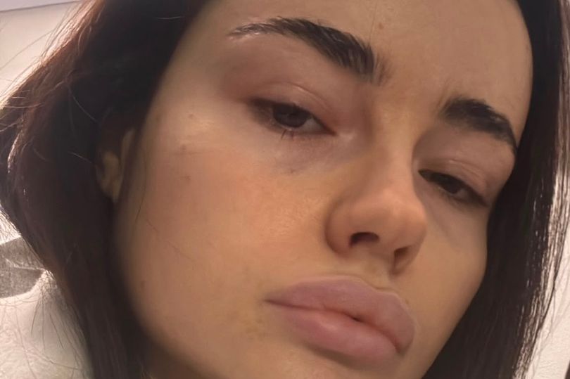 'I hate my £8k Love Island face transformation - family don't even recognise me'