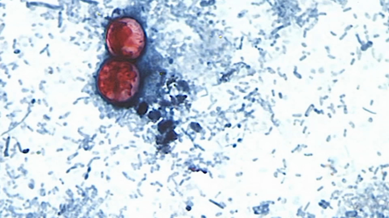 North Carolina Cyclosporiasis cases rise to 718, hospitalizations reach 24 - AOL