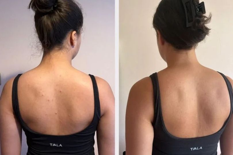KP and stretch mark-sufferers see 'great results on dry bumpy legs' with £15 wipes