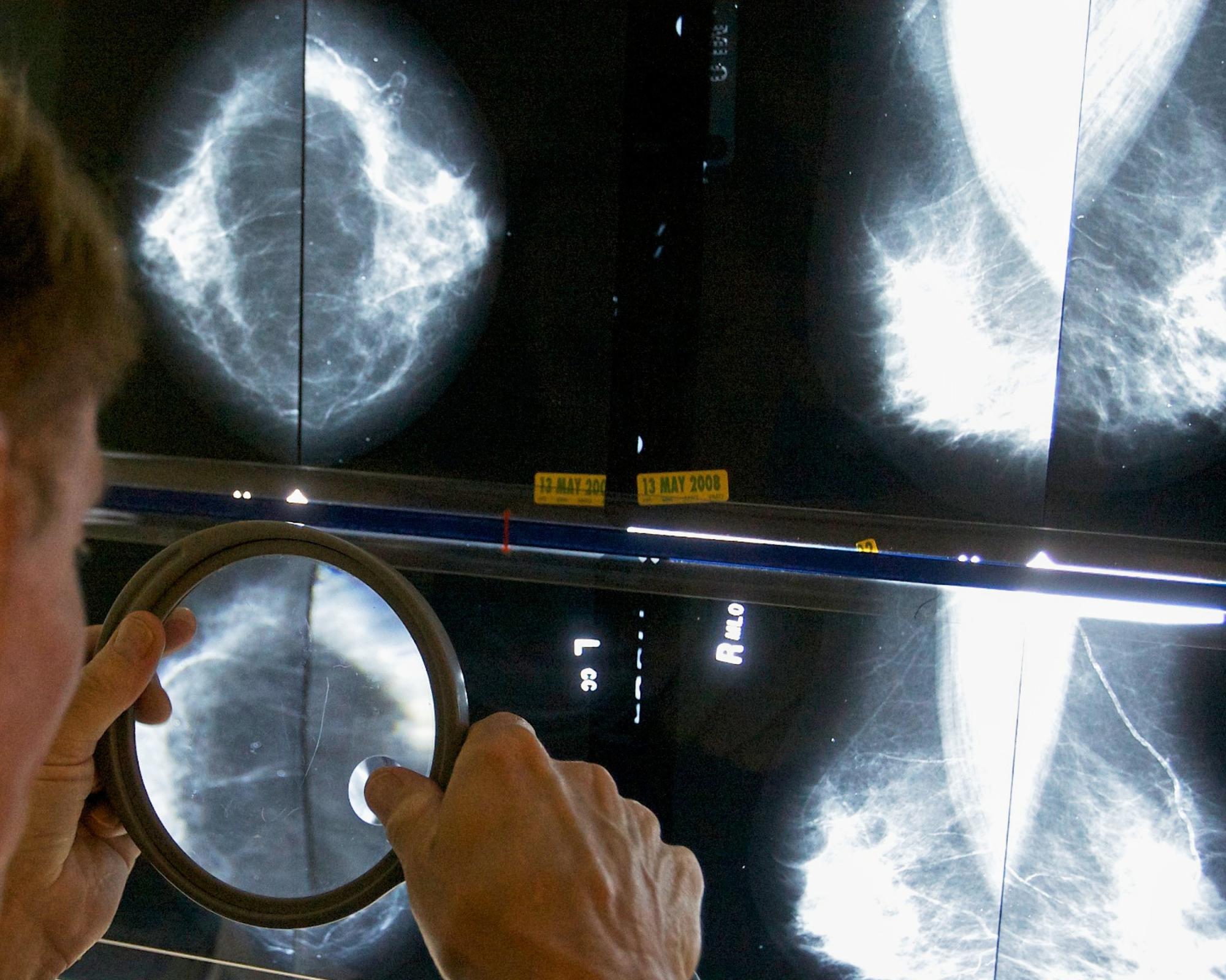 GPs' breast cancer guidelines ‘miss' 95% of women who will develop disease