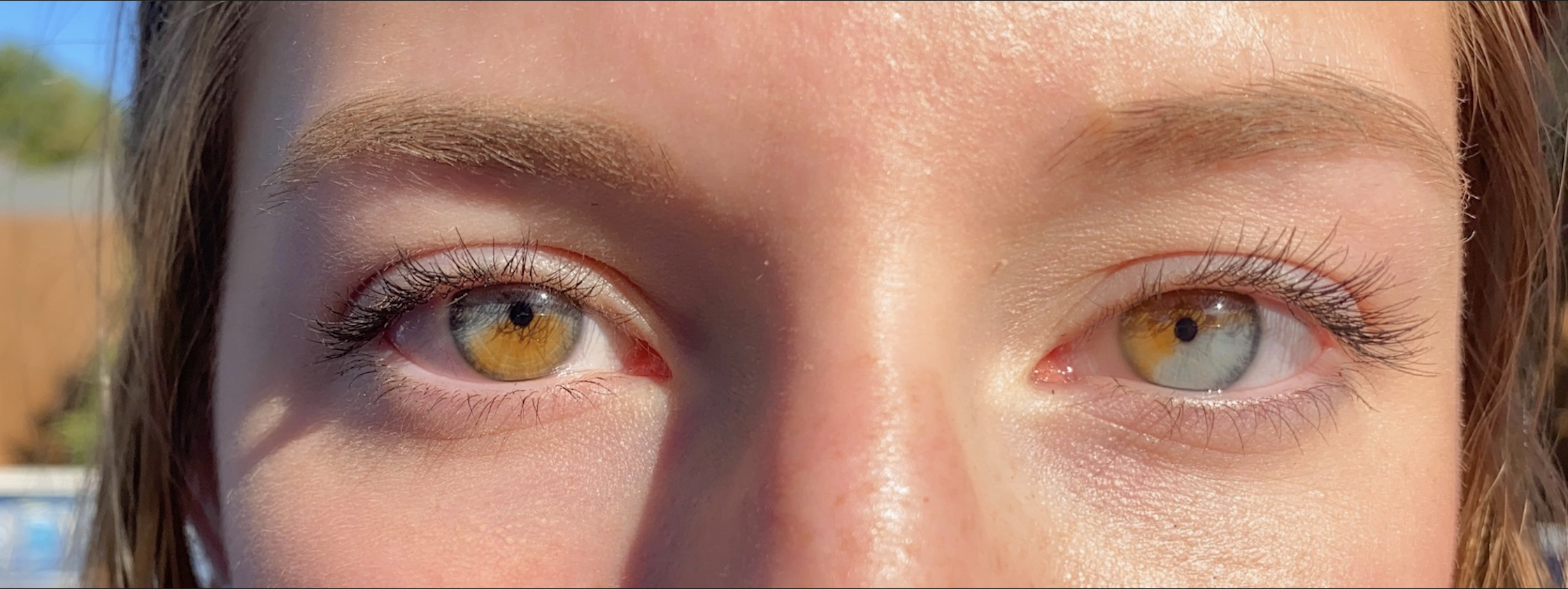 A close-up of a person’s face showing two eyes with heterochromia: the left eye is brown with a hint of green, and the right eye is mostly pale blue with some amber near the pupil.