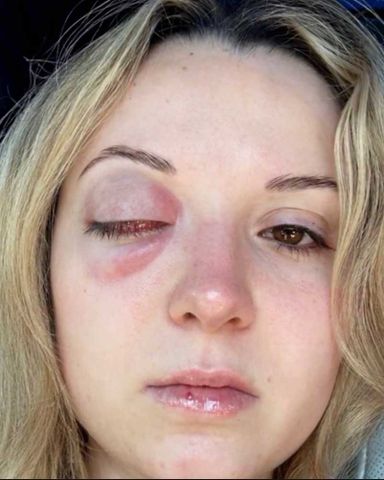 “ER: Caught on Camera”: Woman, 21, Documents Getting Eyeball Removed After It Was ‘Rotting In My Head’ (Exclusive)