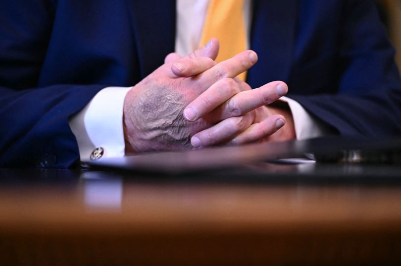 New Photo - Trump's hands ‘decaying from the inside out’ as health fears explode amid waist bulge and hair color drama