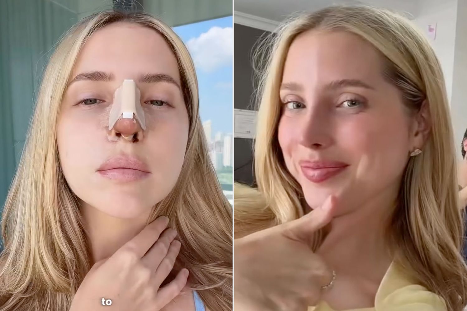 After 10 Years of ‘Hiding’ How Unhappy She Was with Her Nose Job, She Finally Fixed Her ‘Failed Rhinoplasty’