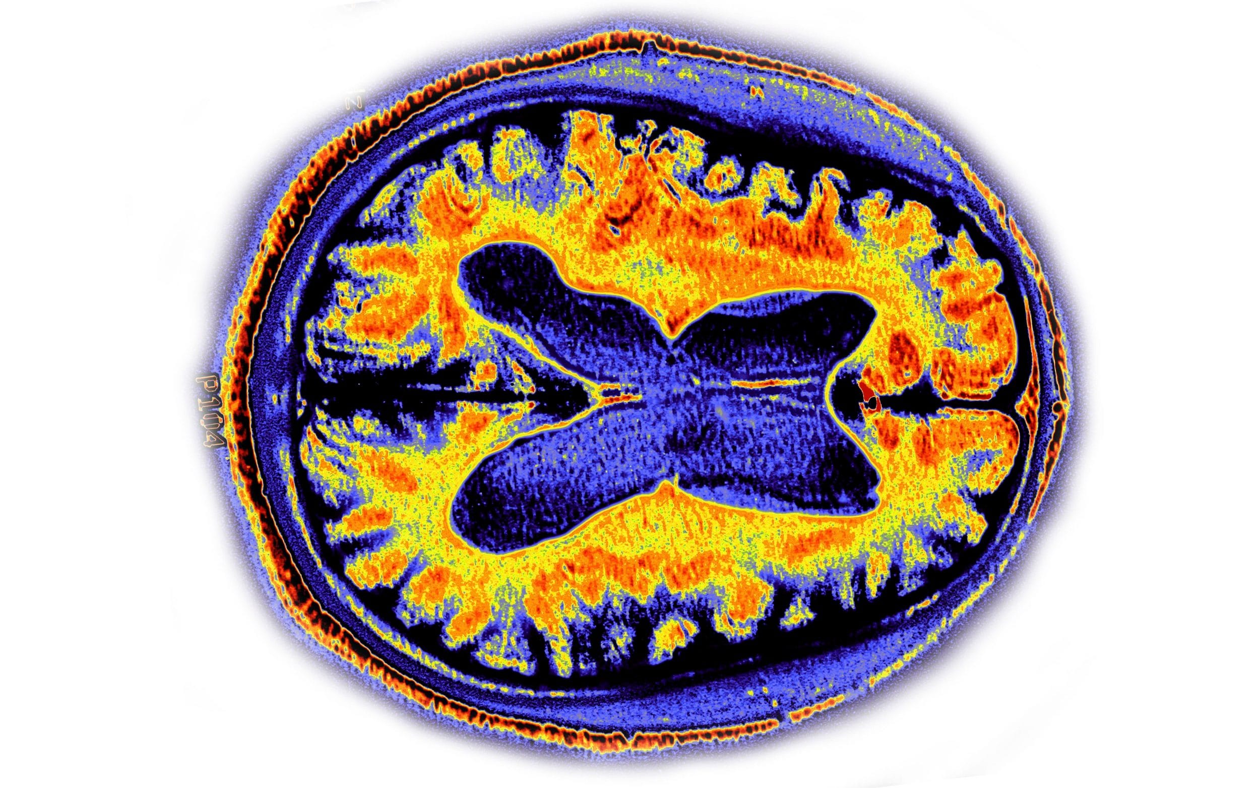 NHS hits dementia diagnosis target but patients still denied key drugs