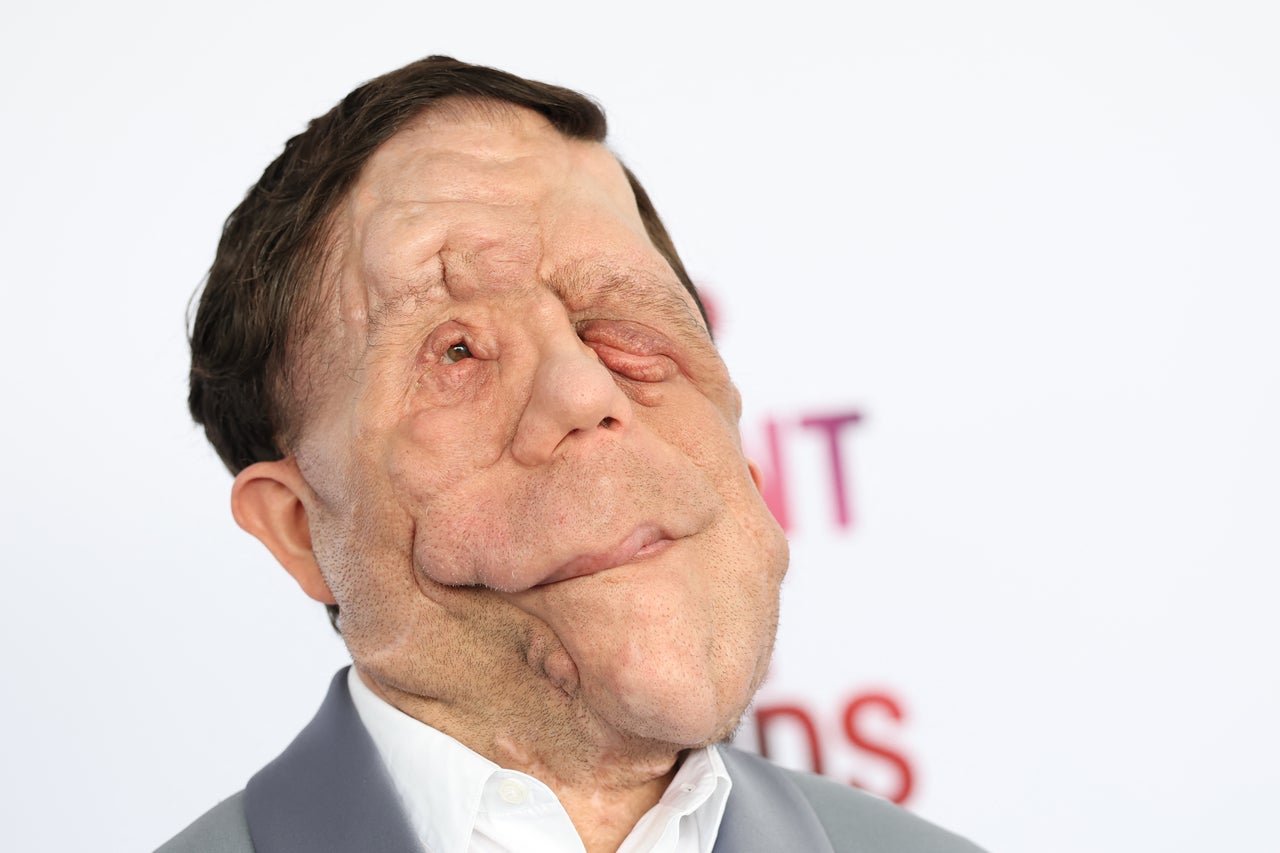 Adam Pearson reveals he was hit by car on way to Under the Skin audition